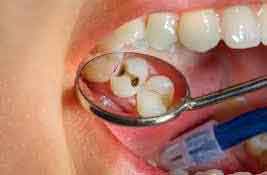 Berkumur Dengan Minyak Goreng Ternyata Dapat Mengobati Sakit Gigi