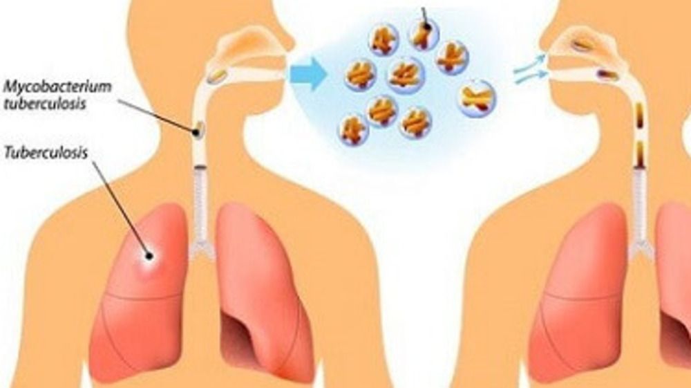 Tak Bisa Dianggap Remeh, Wajib Kenali Bahaya, Gejala, dan Upaya Pengobatan TBC yang Tepat