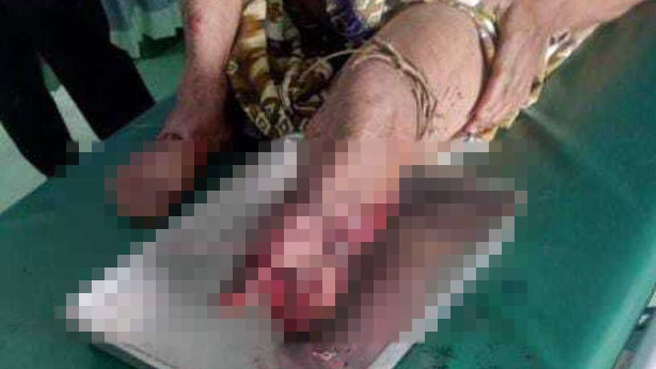 Diserang buaya kaki warga Megang Sakti Putus