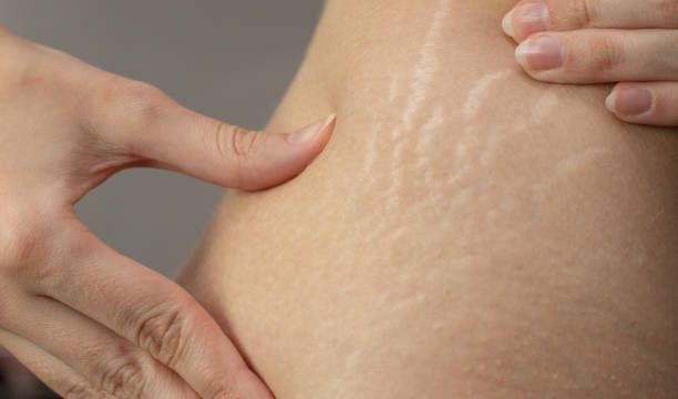 Tips Memudarkan Stretch Mark pada Tubuh