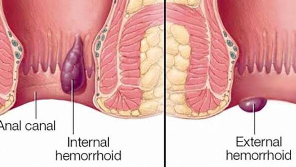 Anda Menderita Ambien? Ini Pantangan yang Wajib Dihindari