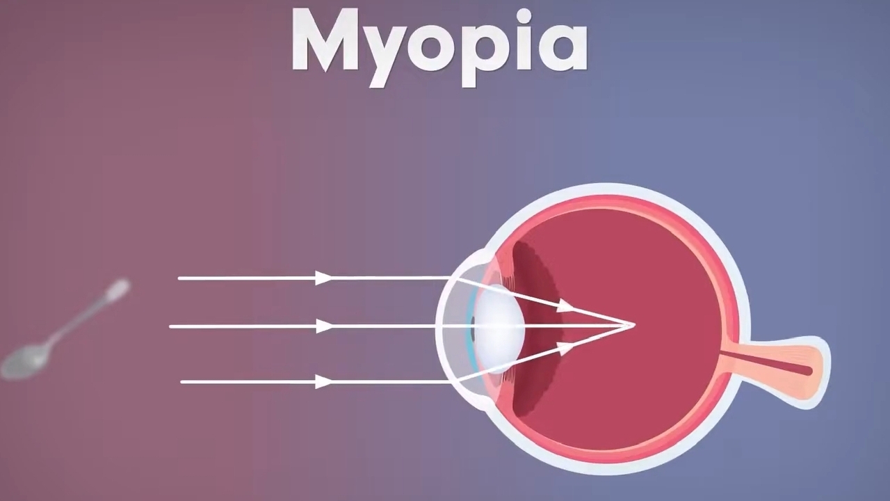 Objek Jauh Sulit Terlihat: 3 Cara Ini Bisa Dilakukan untuk Mengatasi Mata Minus!