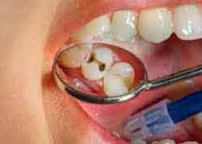 Berkumur Dengan Minyak Goreng Ternyata Dapat Mengobati Sakit Gigi