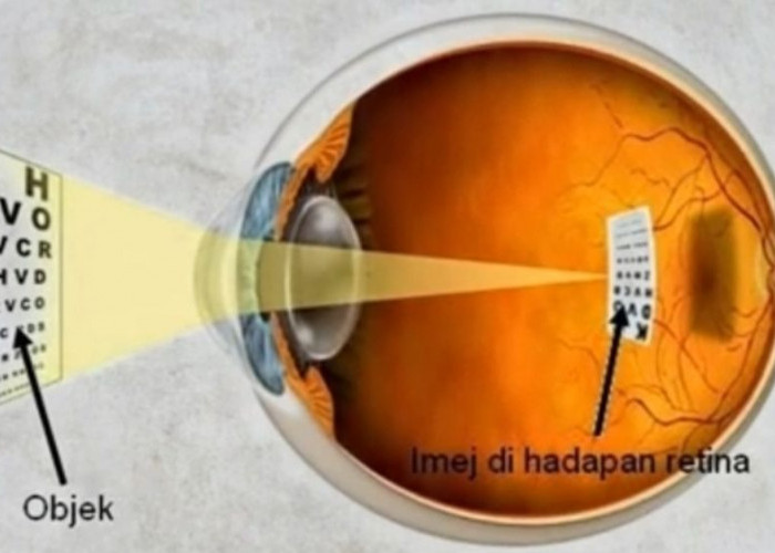 Kekurangan Vitamin D Beresiko Mengalami Miopi, Konsumsi 5 Makanan ini untuk Menjaga Kesehatan Mata