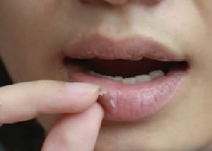 Mengatasi Bibir Kering Saat Puasa: Tips dan Trik Untuk Kesehatan yang Optimal