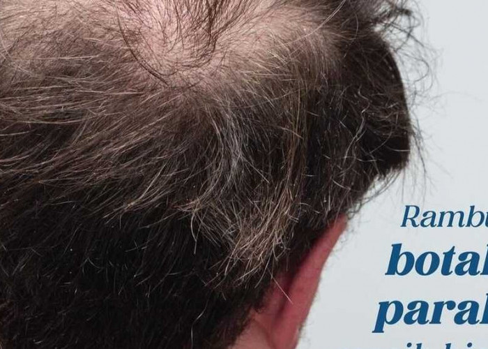 Kunci Solusi Mengatasi Kebotakan Rambut pada Pria: Panduan Lengkap dan Efektif