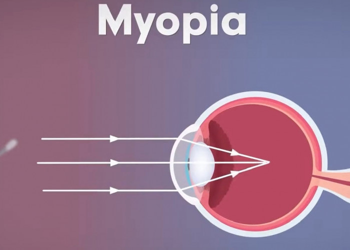 Objek Jauh Sulit Terlihat: 3 Cara Ini Bisa Dilakukan untuk Mengatasi Mata Minus!